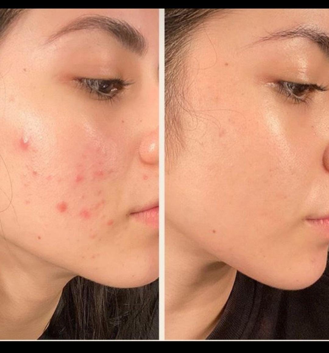Skin — Before & After